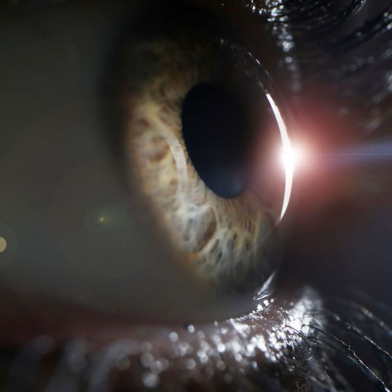 Cirugía Refractiva Láser (LASIK)