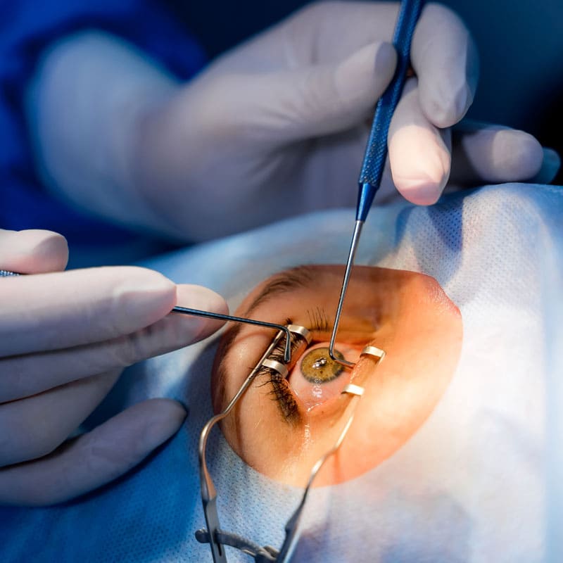 Cirugía de Cataratas (Microcirugía)