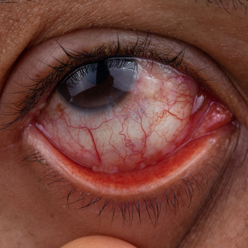 Conjuntivitis Alérgica