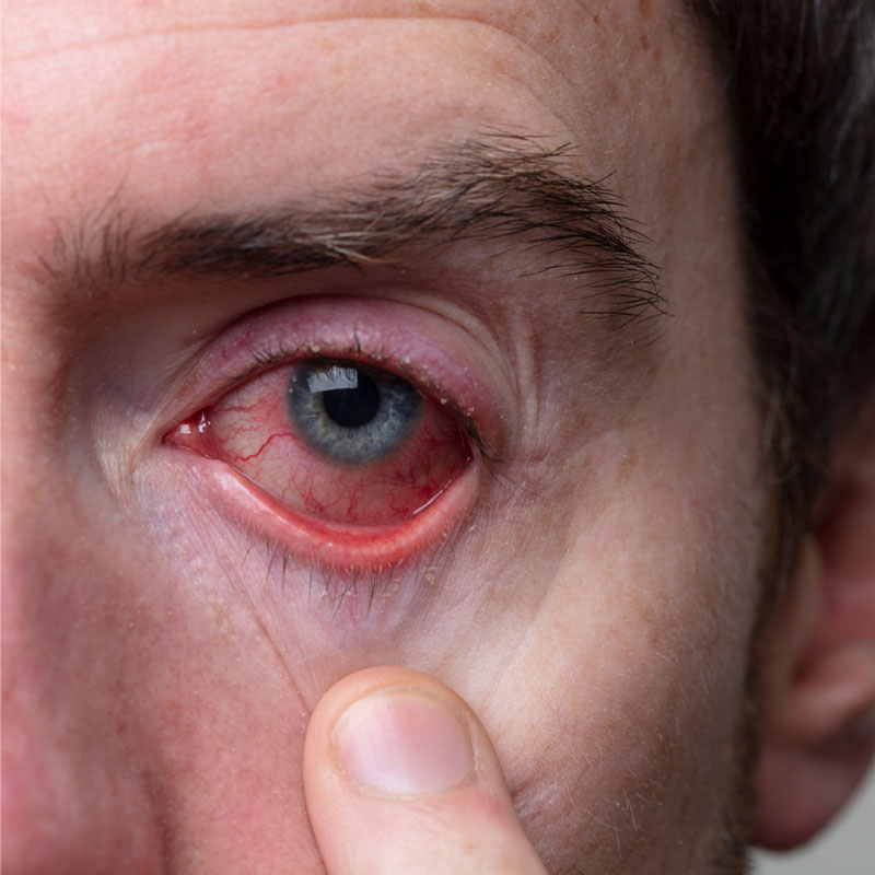 Infecciones Oculares