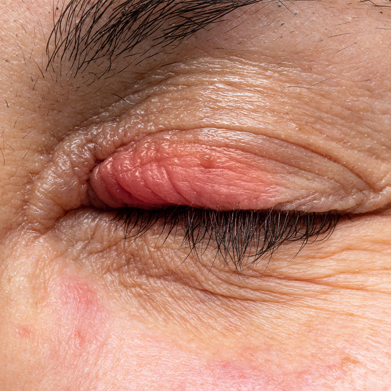 Lesiones en los Párpados