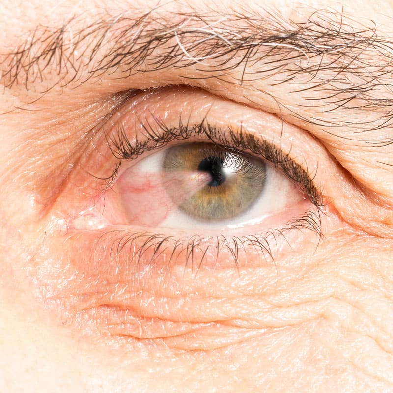 Pterigión o Carnosidad